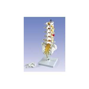 Lumbar Spinal Column with dorso lateral prolapsed intervertebral disc