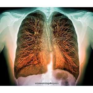  Lungs, 3D MRI scan Framed Prints